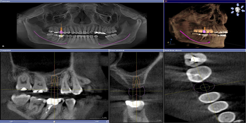 Sinus Lift Bone Grafting at PERFECT SMILE